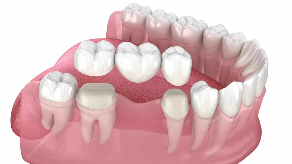 Dental implant 